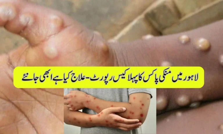 Lahore Confirms First Monkeypox Case, Patient Isolated at General Hospital